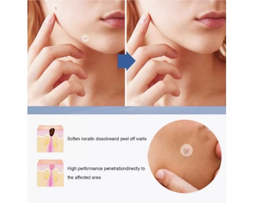 Гидроколлоидные патчи от прыщей Skin Tag оптом